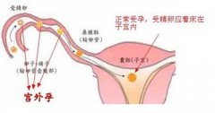 宫外孕的手术治疗方法有哪些