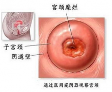 治疗宫颈糜烂需要多长时间