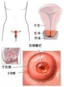 宫颈糜烂做什么检查