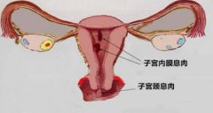 得了宫颈息肉多长时间能治好