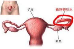 输卵管积水的检查