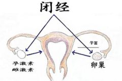 闭经怎么办
