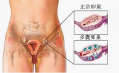 <b>哪些因素容易引起多囊卵巢</b>